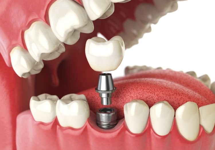 Single Tooth Implants in Mclean, VA